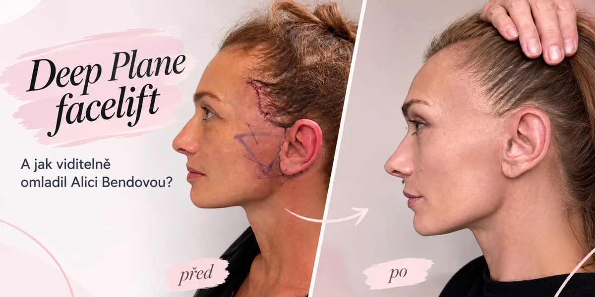 Všechno, co potřebujete vědět o deep plane faceliftu, zákroku, který viditelně omladil Alici Bendovou