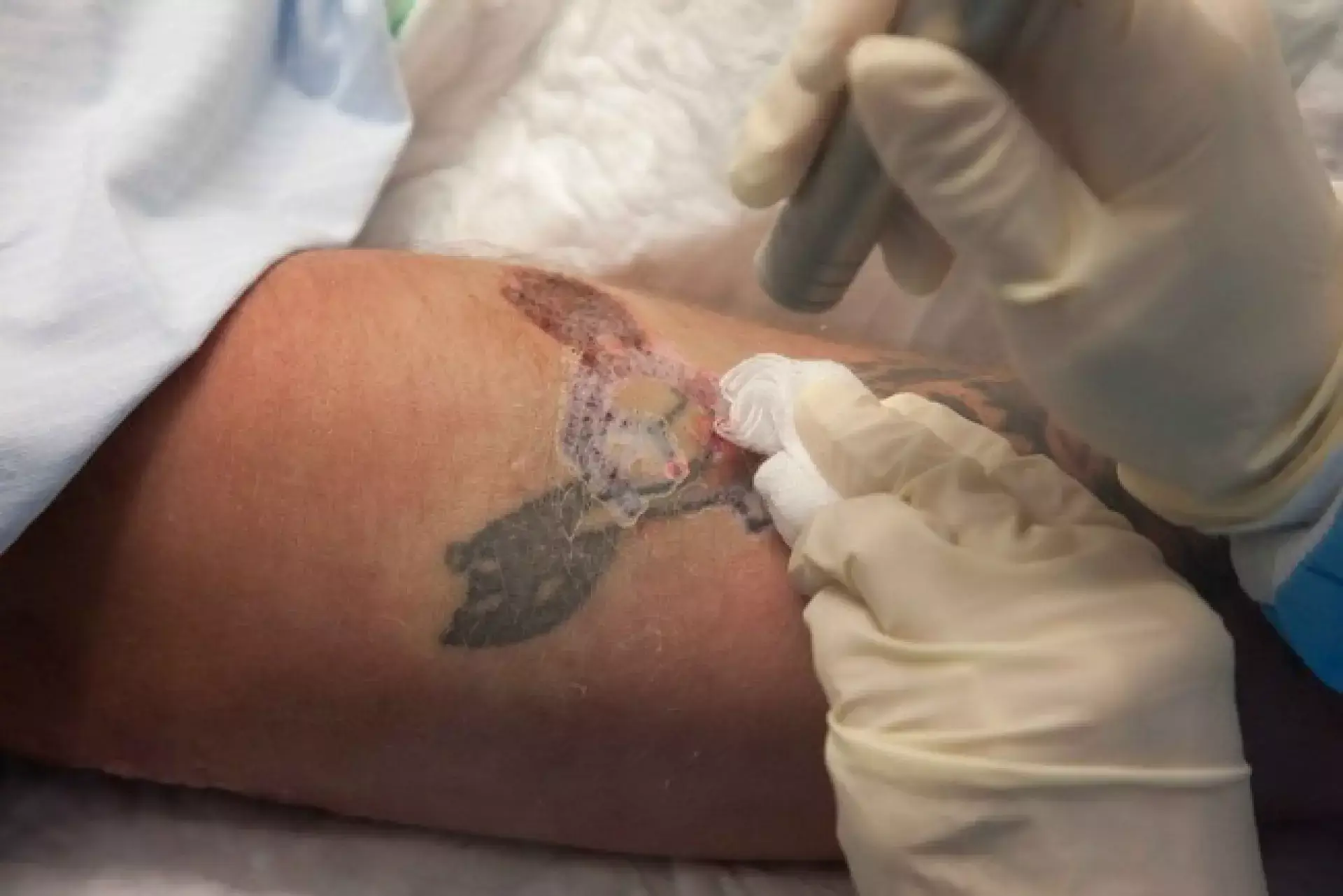 Odstranění tetování