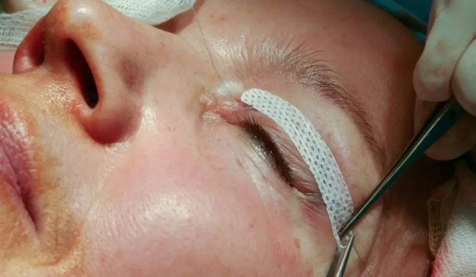 Operace očních víček